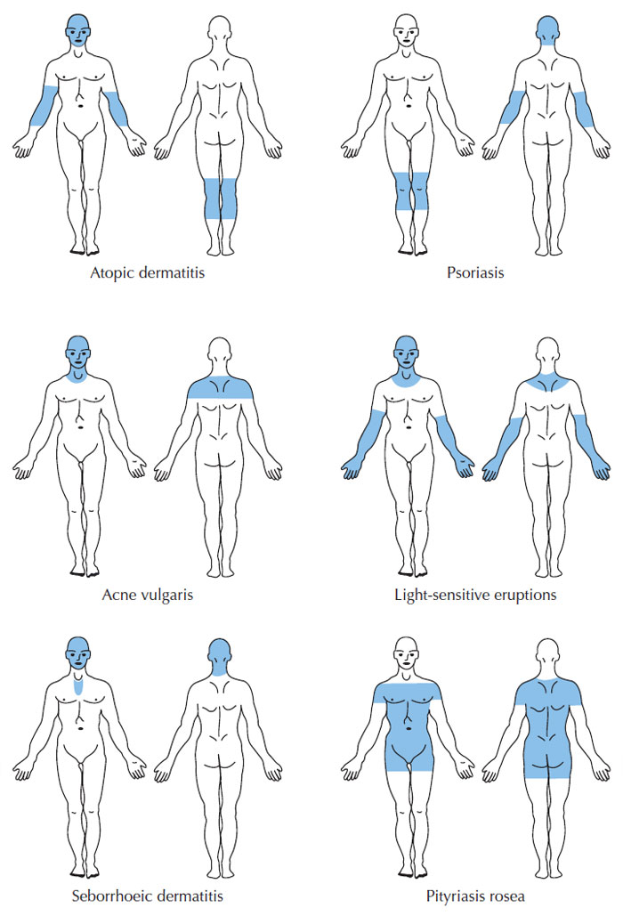 Figure 3.9 Classic lesion distribution in common skin disorders (Mackie, 2003).