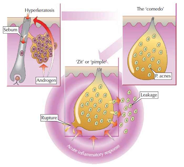 Figure 10.1 Acne pathogenesis. (Source: Reprinted from Graham-Brown and Burns, 2006.)