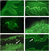 Figure 3.30 A: DIF, pemphigus vulgaris (Courtesy of Dr. Iris K. Aronson) B: DIF, bullous pemphigoid (Reprint from Norman R, ed. Diagnosis of Aging Skin Diseases, New York, NY: Springer; 2008) C: DIF, dermatitis herpetiformis (Courtesy of Dr. Paul Getz) D: DIF, lupus erythematosus (Courtesy of Dr. Paul Getz) E: IIF on SSS, EBA (dermal side) (Courtesy of Dr. Lawrence Chan) F: IIF on SSS, bullous pemphigoid (epidermal side) (Reprint from Norman R, ed. Diagnosis of Aging Skin Diseases. New York, NY: Springer; 2008)