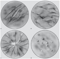 Fig. 8.5a–d. Four types of telangiectasias: a Simple, b arborized, c spider, d papular. (Reprinted with permission from Goldman MP (1991) Sclerotherapy: Treatment of varicose and telangiectatic leg veins. Mosby, St. Louis.)