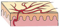 Telangiectasia.