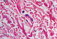 Larva currens. Biopsy demonstrates migrating larva of Strongyloides stercoralis in the dermis. (Courtesy of the Fitzsimons Army Medical Center teaching files.)