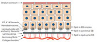 Layers of the skin with major sites of splitting in epidermolysis bullosa (EB). (Courtesy of James E. Fitzpatrick, MD.)